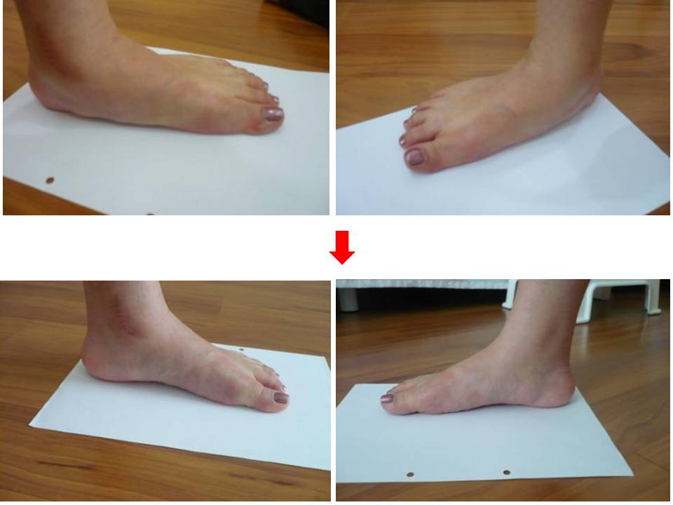 Result of Flat Foot after four sessions of WMQ treatment